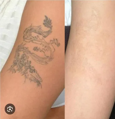 Удаление татуировки