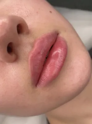 Увелечение губ 700000 ,а так же на все процедуры скидки