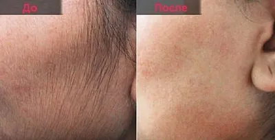 AFT Эпиляция. Лазерная эпиляция. Избавление от нежелательных волос.