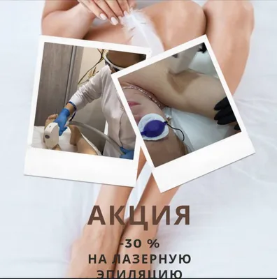 Лазерная эпиляция