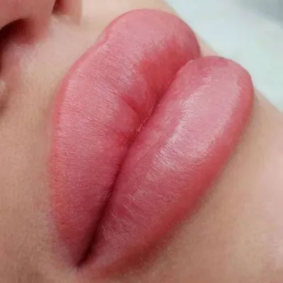 Губы,ботокс в Ташкенте