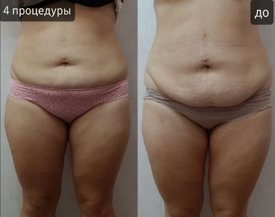Липолитики тело, живот, бока, руки, ноги