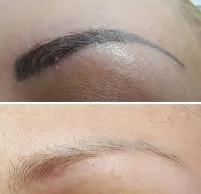 Удаление татуажа и тату