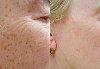 Мезотерапия, Mezoterapiya, Косметолог, Kosmetolog