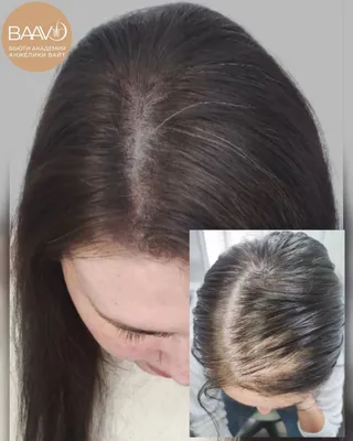 Трихопигментация волос