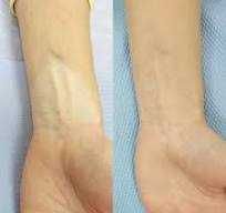 Vitiligo kamuflyaji