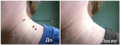 Удаление папиллом, электрокоагуляция и лазер. Papilloma yo'qotish.