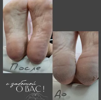 педикюр лечебный подолог на дому !