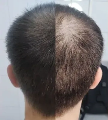 Трихопигментация волос