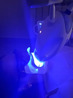 Отбеливание зубов системой Zoom4