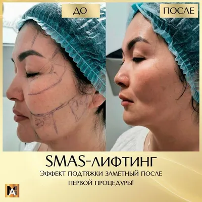 SMAS лифтинг. Безоперационная подтяжка лица. Ультразвуковой лифтинг.