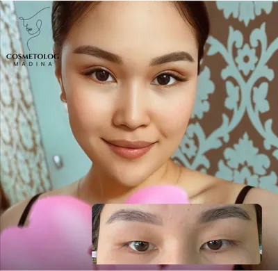 Skidkada Blefaraplastika, podborodka olish kesmasdan va boshqa muolaja