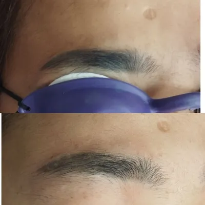 Удаление старого татуажа