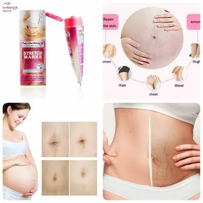 Крем от растяжек Массажный крем от растяжек