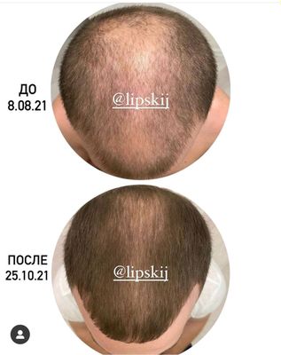 soch, soqol, qosh va kipriklarni samarali òstirish