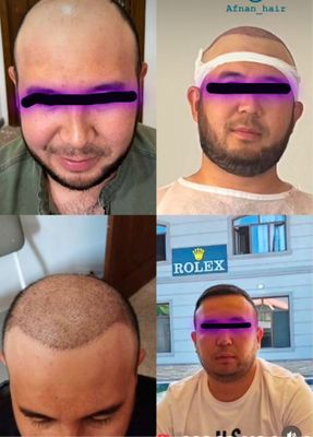 Soch Ekamiz 100% Garantiya