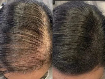 Трихопигментация волос