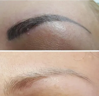 Удаление старого татуажа лазером