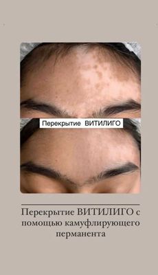 Витилиго камуфляж