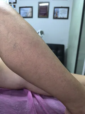 Акция Депиляция Шугаринг