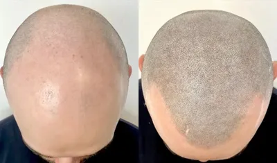 Трихопигментация волос