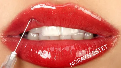 Наполнители губы,филлеры в Tashkente