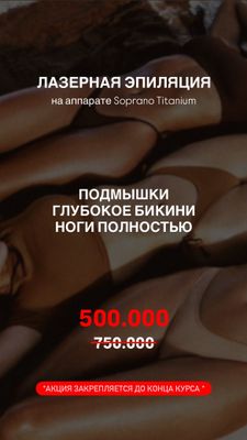 Лазерная эпиляция