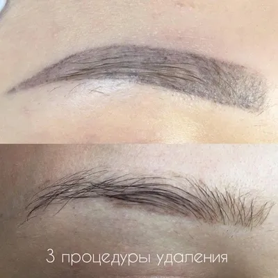 Удаление татуажа и татуировок лазером и ремувером