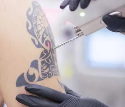 Удаление татуировок. Лазерное удаление татуировки в Ташкенте.