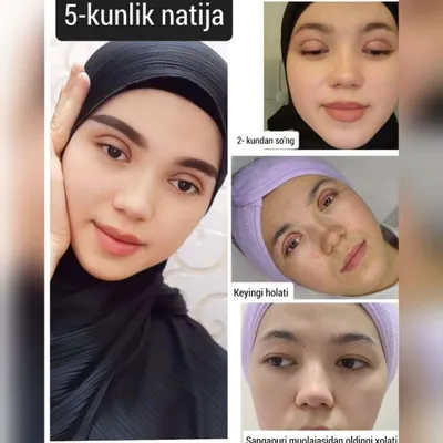 SKIDKADA (Bezoperatsonniy Sangapuri) Browlifting muolajasi