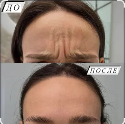 Ботокс лица мезаботокс фуллфейс