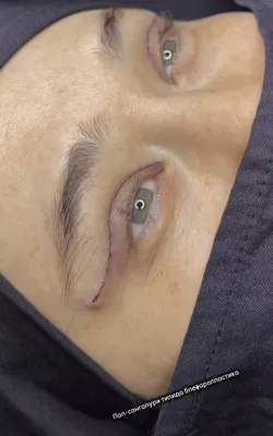 1 oy Skidkada Blefaraplastika ,browlifting, Nitevoy Sangapuri