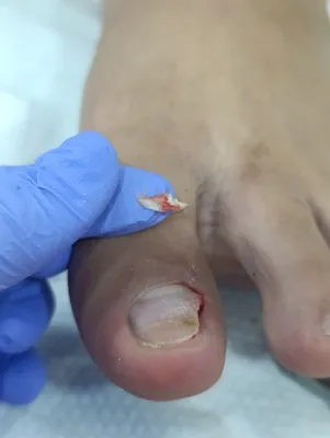 Ичига усган тирнони олиш, титановый нить куйиш хизматимиз бор. Ориксиз