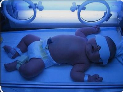 Фотолампа в домашних условиях от желтухи у новорожденных