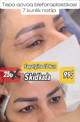 Browlifting, blefaraplastika, Sangapuri muolajasi SKIDKADA