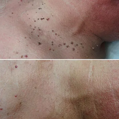 Удаление папиллом