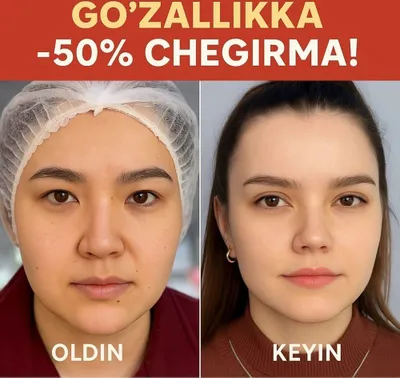 50% chegirmada blefaroplastika