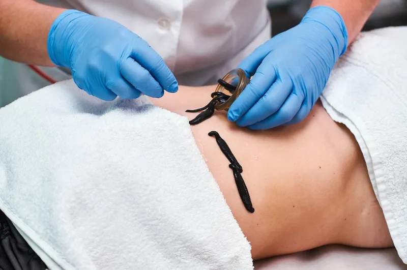 Мануальная терапия, иглоукалывание, хиджама Мануальная терапия, иглоукалывание, хиджама