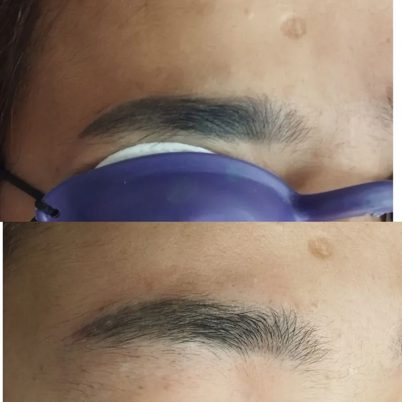 Удаление старого татуажа Удаление старого татуажа