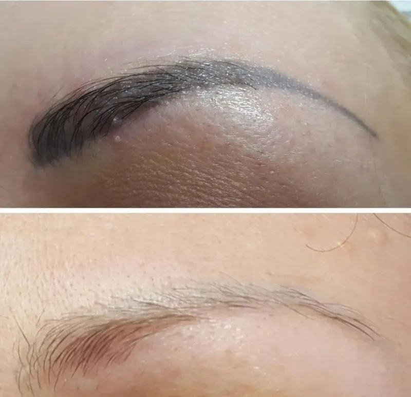 Удаление старого татуажа лазером Удаление старого татуажа лазером