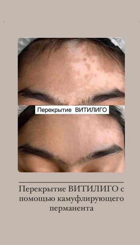 Витилиго камуфляж