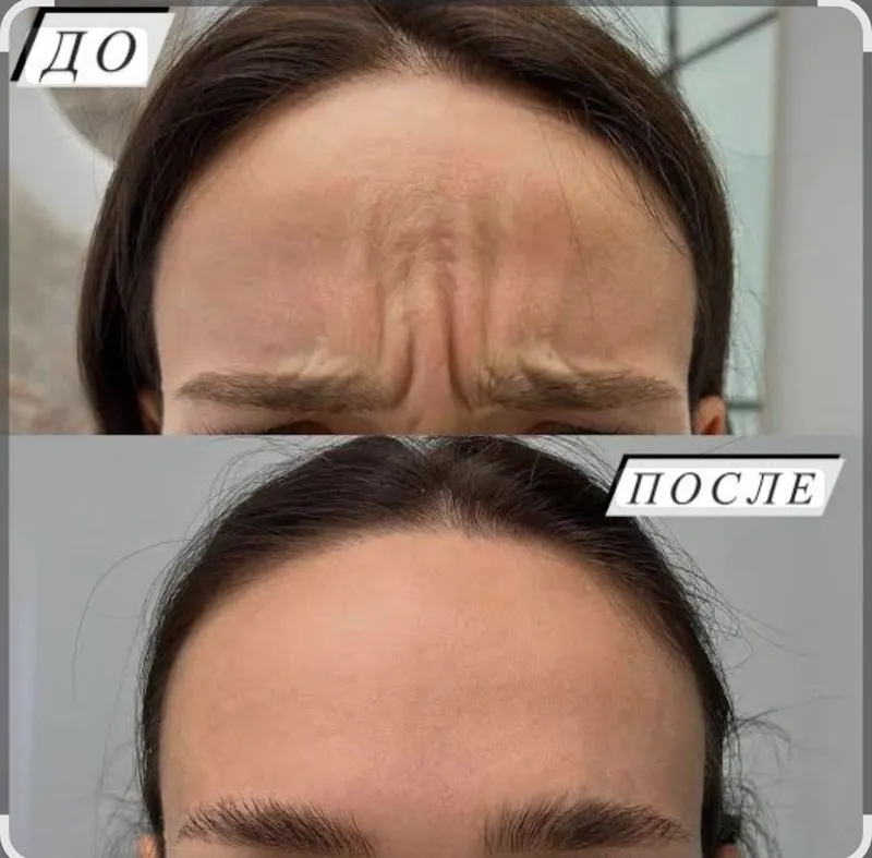 Ботокс лица мезаботокс фуллфейс