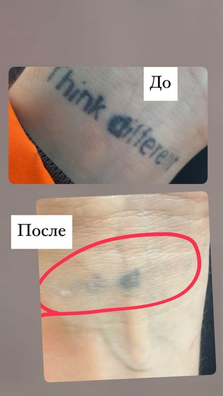 Удаление любых татуировок Удаление любых татуировок