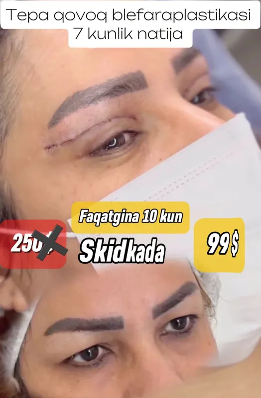 Browlifting, blefaraplastika, Sangapuri muolajasi SKIDKADA Browlifting, blefaraplastika, Sangapuri muolajasi SKIDKADA